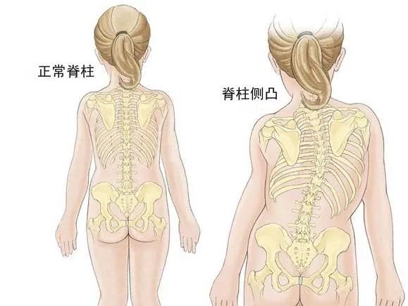 青少年睡姿不對(duì)，真能把脊柱睡“彎”嗎？